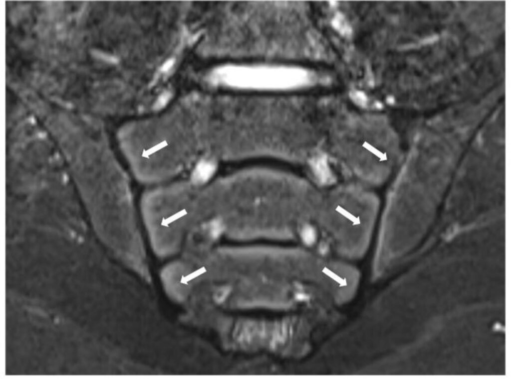 Figure 1: Normal maturational signal in youth along the sacroiliac joints